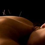 acupuncture