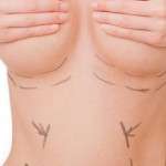 Opération d'augmentation mammaire