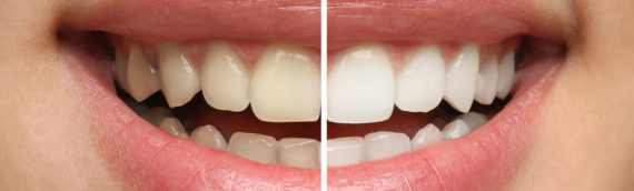 Est-il possible de se faire blanchir les dents sans danger ?