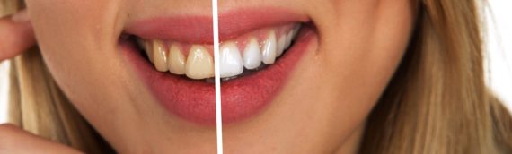 Des dents blanches de manière naturelle c’est possible.