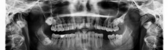 Comment trouver la meilleure mutuelle orthodontie ?