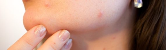Lutter contre l’acné: connaître ses causes, symptômes et traitements