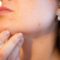 Lutter contre l'acné: connaître ses causes, symptômes et traitements