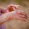 Eczéma : l'hydratation est la clé